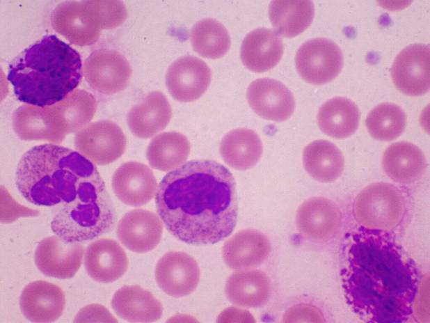 Peripheral Blood Film in CML showing blast cells: