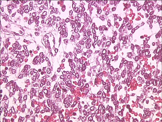 Yolk Sac Tumor. Of jul may yolk sac tumors