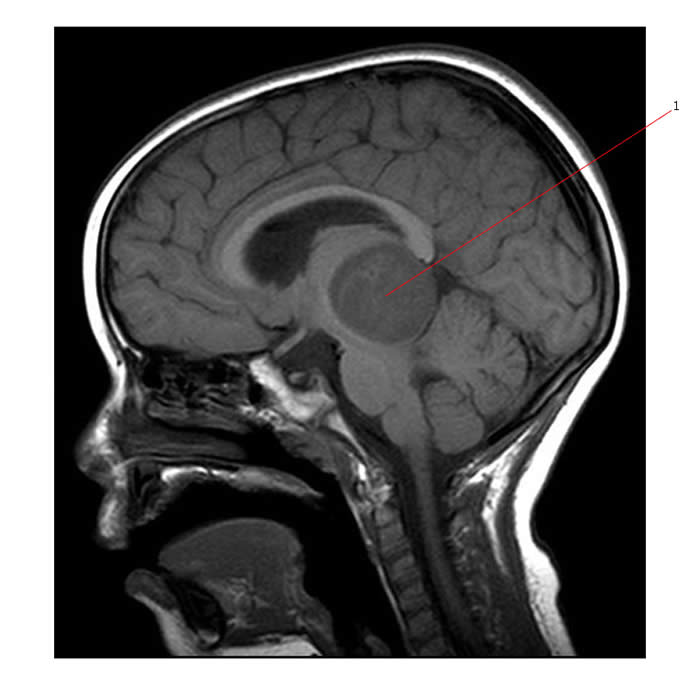 Below is a MR scan (T2, axial) of a glioblastoma multiforme(#1) involving t...