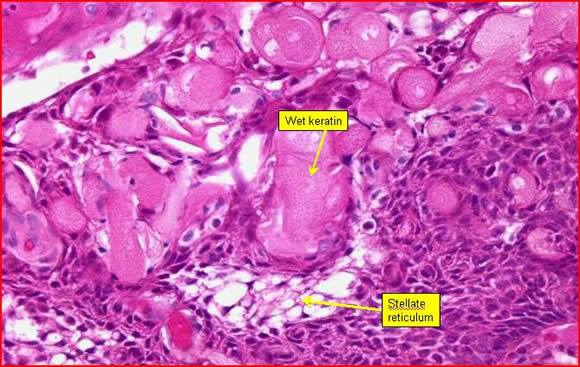 Squamous cell skin cancer: MedlinePlus Medical Encyclopedia